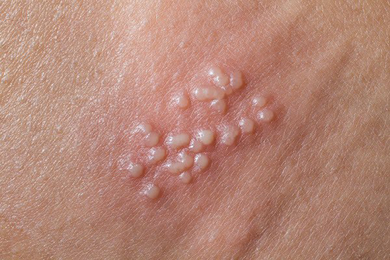 Khái niệm cơ bản về mụn cóc và sùi mào gà