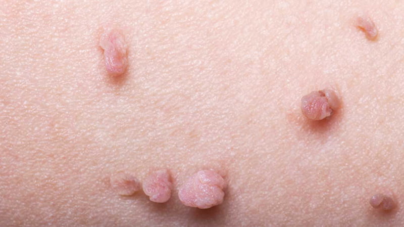Mất bao lâu để khỏi mụn cóc?