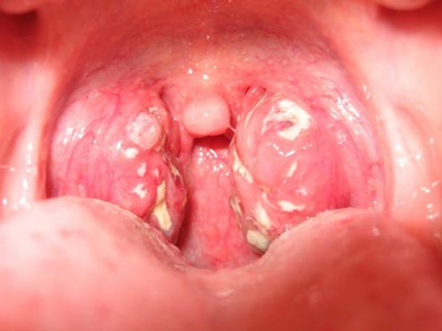 Bệnh lậu ở miệng, họng: Dấu hiệu và cách chữa trị