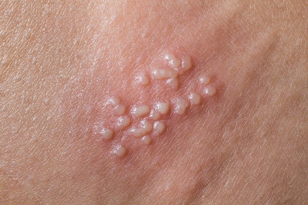 Bệnh lậu: Thời gian điều trị và những điều cần biết