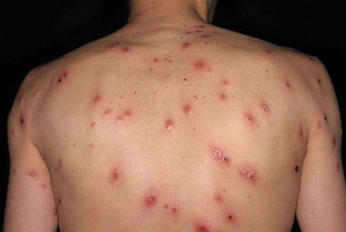 Đặc điểm của bệnh giang mai | G3VN