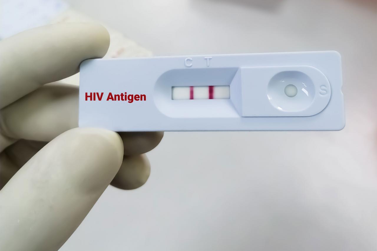 Các câu hỏi thường gặp khi tham gia xét nghiệm HIV