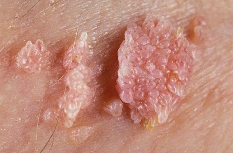 Nguyên nhân gây bệnh và điều trị bị bệnh sùi mào gà ở nam giới