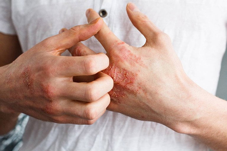 Bệnh giang mai theo từng giai đoạn