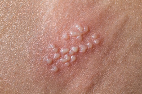 Phân biệt bị bệnh lậu với các bệnh xã hội khác | bệnh lậu ở miệng, bệnh lậu giang mai