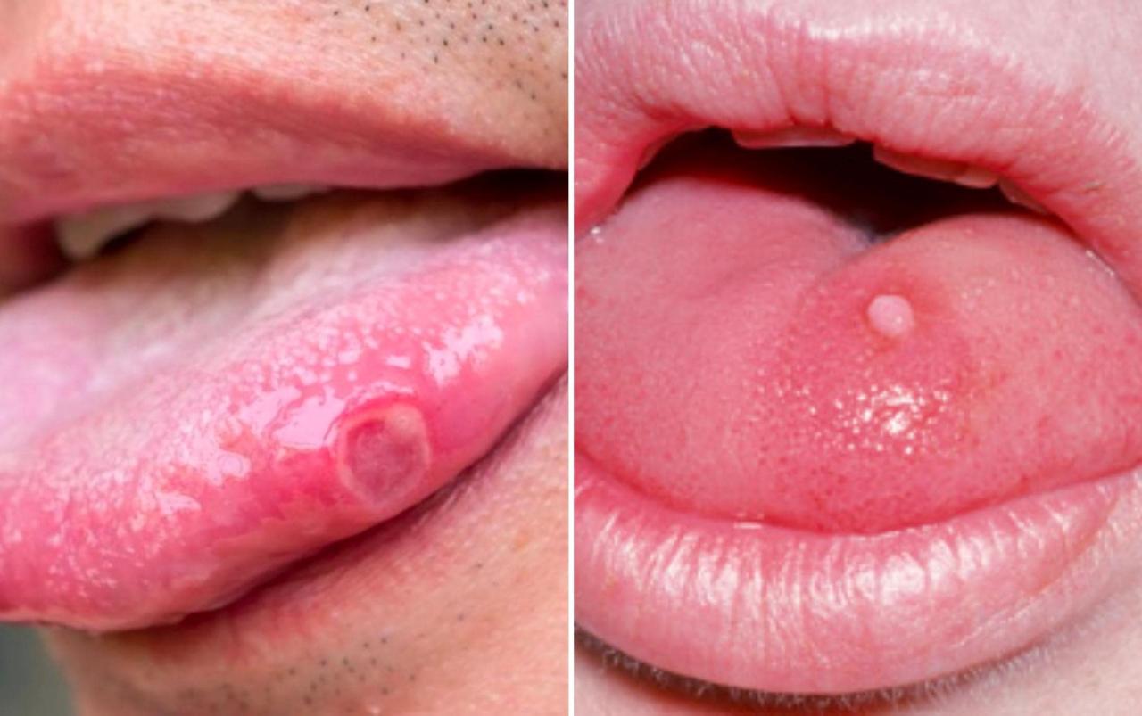 Sùi mào gà ở lưỡi: nguyên nhân, triệu chứng và cách điều trị