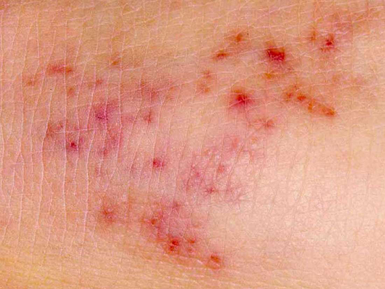 Phát ban đỏ HIV là gì? biểu hiện phát ban của HIV