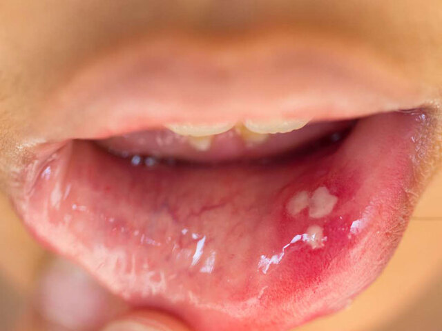 Bệnh sùi mào gà ở miệng và tác hại của bệnh như thế nào